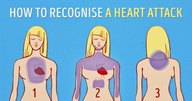 Cách nhận biết ra cơn đau tim 1 tháng trước khi phát bệnh
